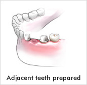 adjacent teeth prepared